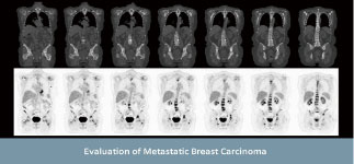 PET-CT 촬영사진