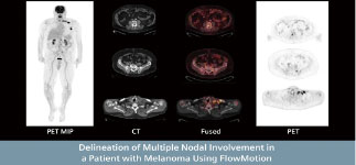 PET-CT 촬영사진